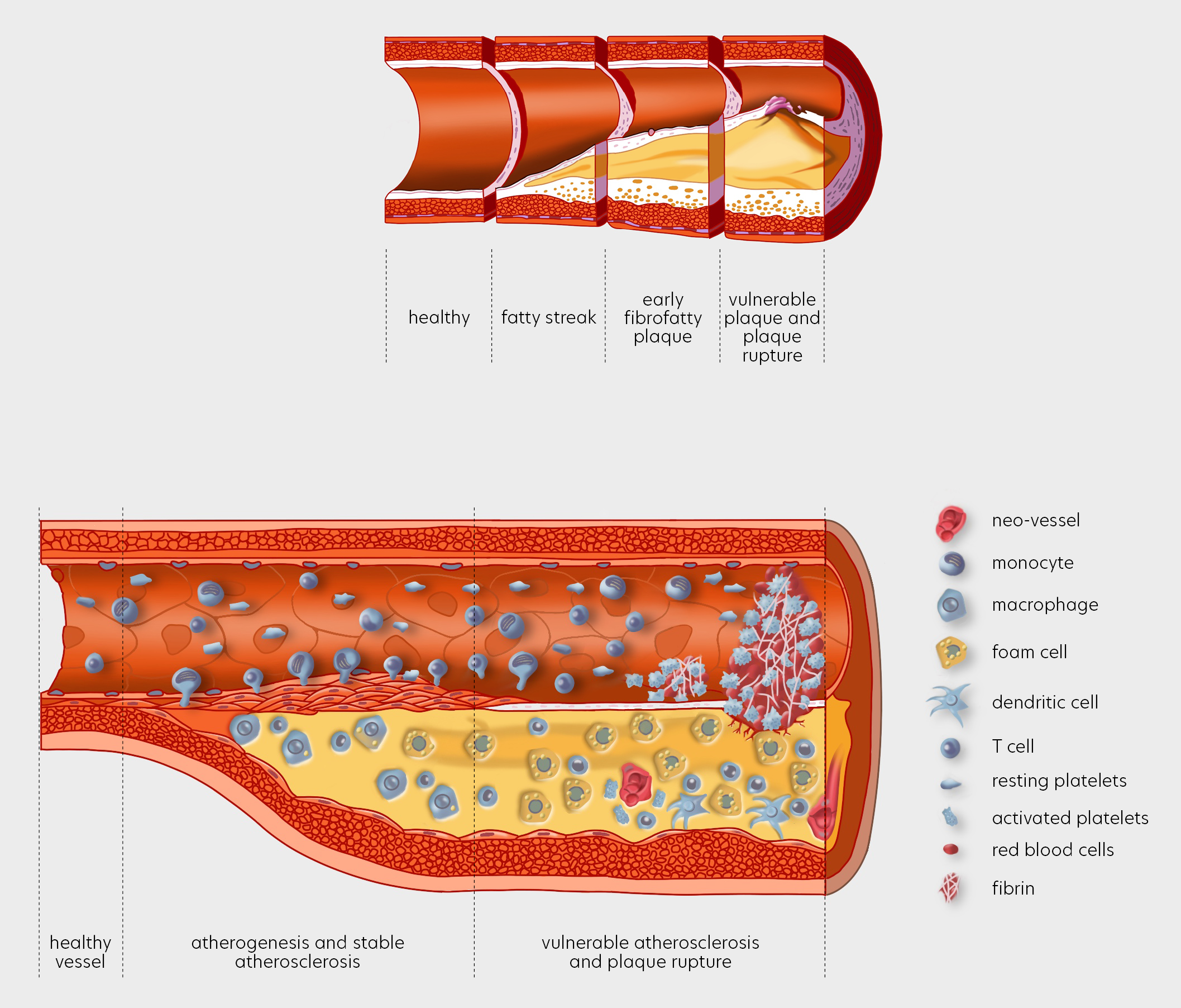 The different stages of an atherosclerotic plaque