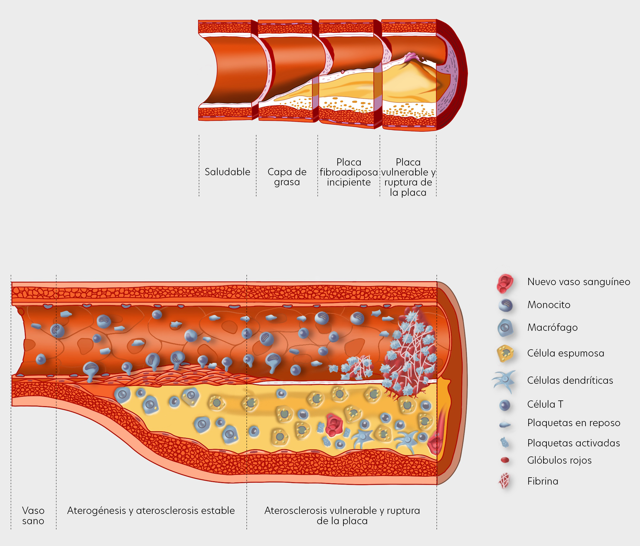 The different stages of an atherosclerotic plaque