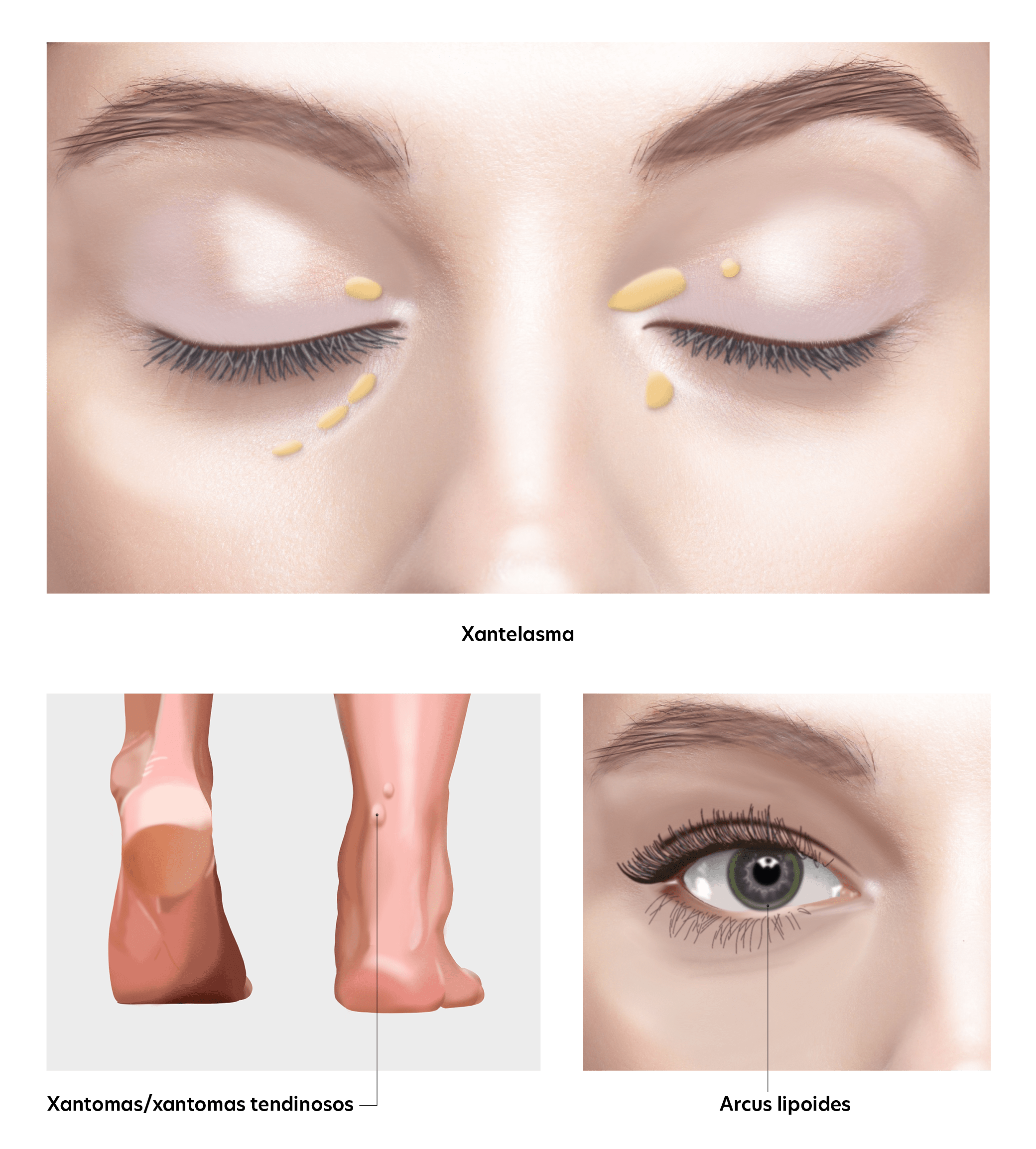 Familial hypercholesterolemia disease phenotype
