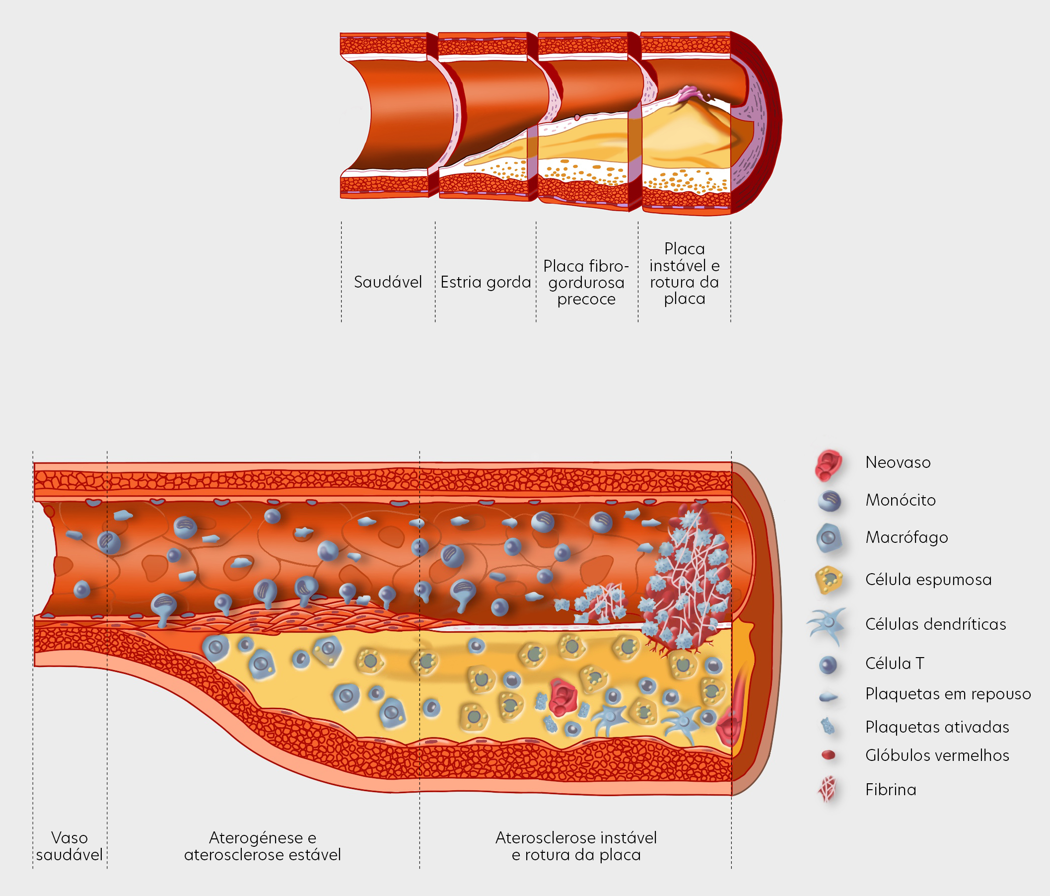 The different stages of an atherosclerotic plaque